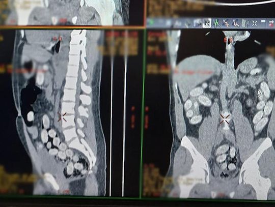 Udaremniony przemyt na Okęciu. Nigeryjczyk połknął ponad kilogram kokainy w kapsułkach