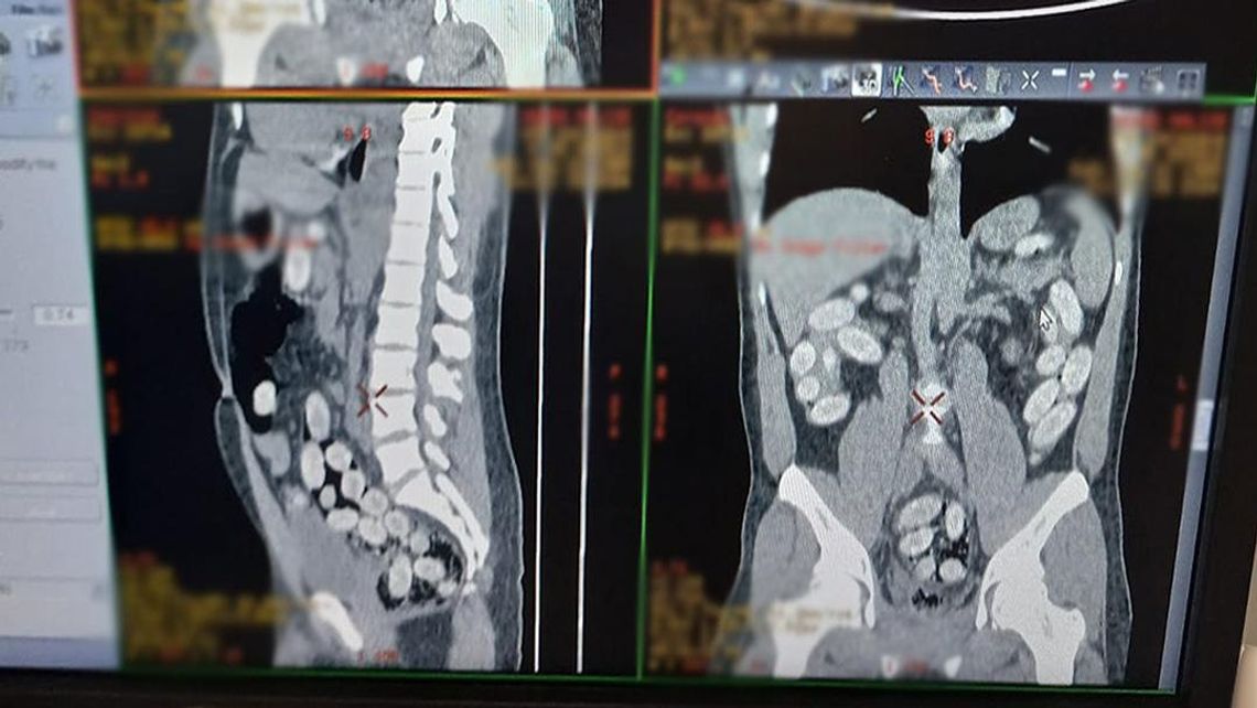 Udaremniony przemyt na Okęciu. Nigeryjczyk połknął ponad kilogram kokainy w kapsułkach